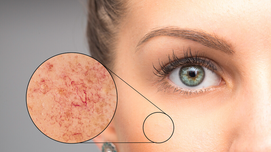 Trądzik różowaty (acne rosacea) &#8211; objawy i przyczyny